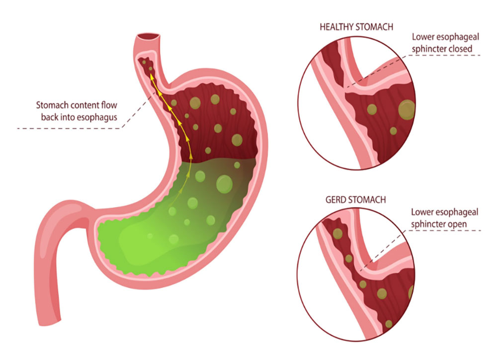 Mechanism of LES valve opening in GERD
